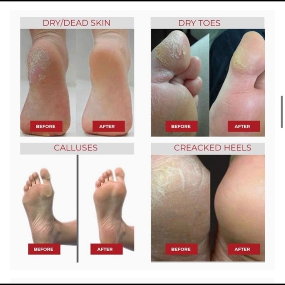 Exfoliating Foot Peel Mask For Softer, Smooth Feet- Gently Peel Away Calluses - Picture 3 of 5